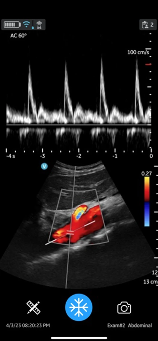 CL Abdominal aorta with color flow and PW doppler