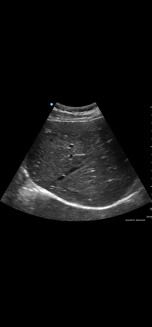 CL Rt lobe liver