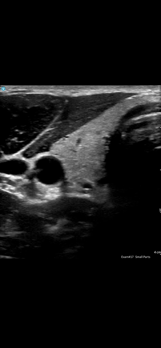 CL Transverse thyroid lobe