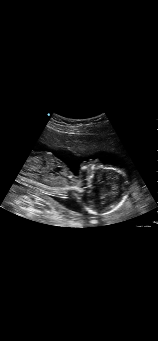 CL fetal profile