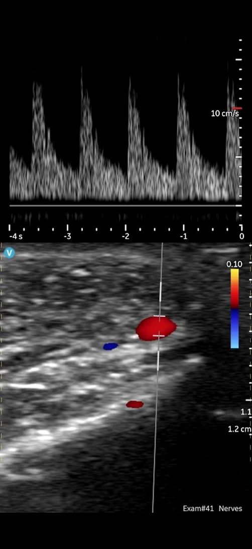 Facial artery