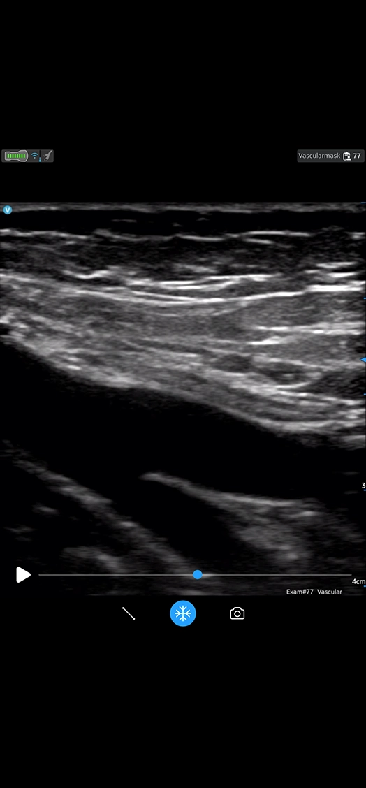 Femoral Vein Perfunda Vein Long Linear