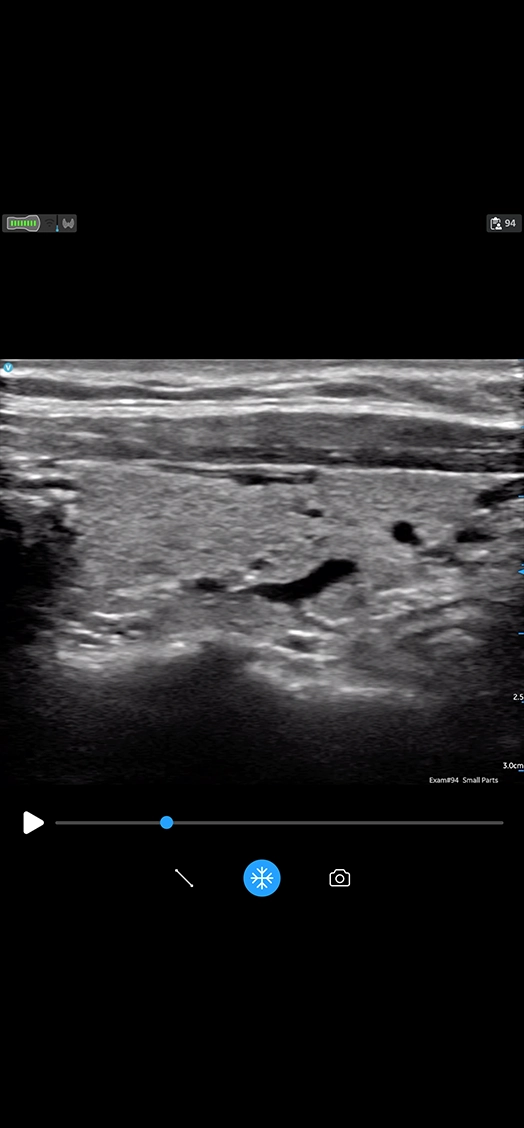 Thyroid Long Linear