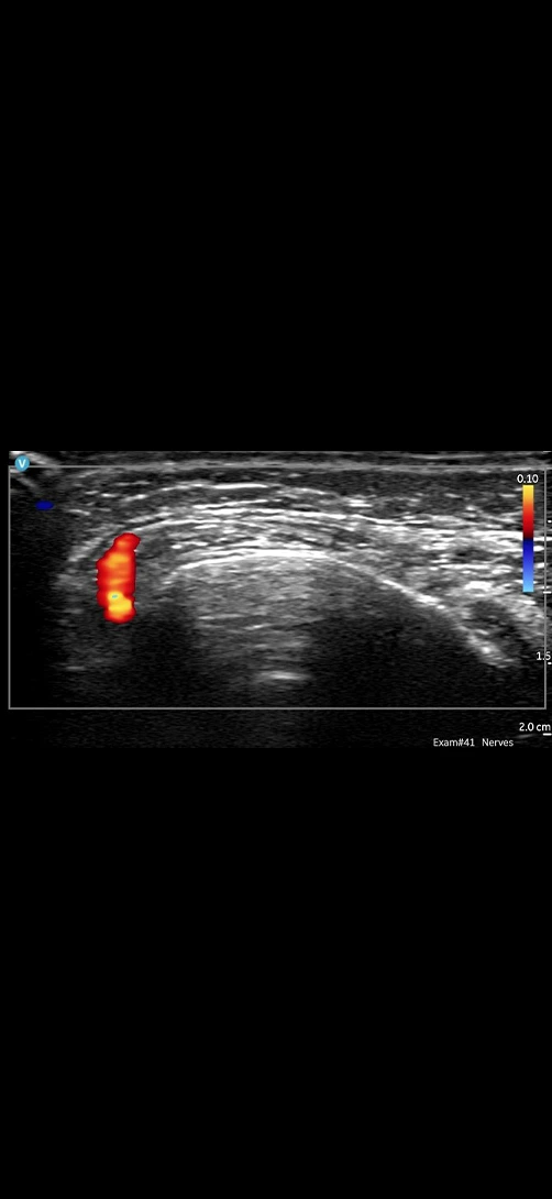 Masseteric artery