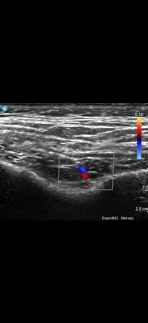 Superficial temporal artery and vein